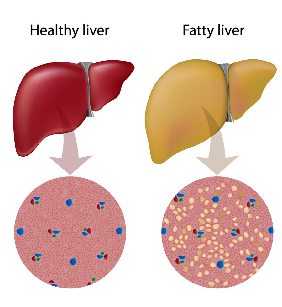 How to Treat Fatty Liver